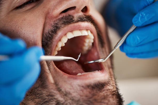 Best Emergency Tooth Extraction in Burleson, TX